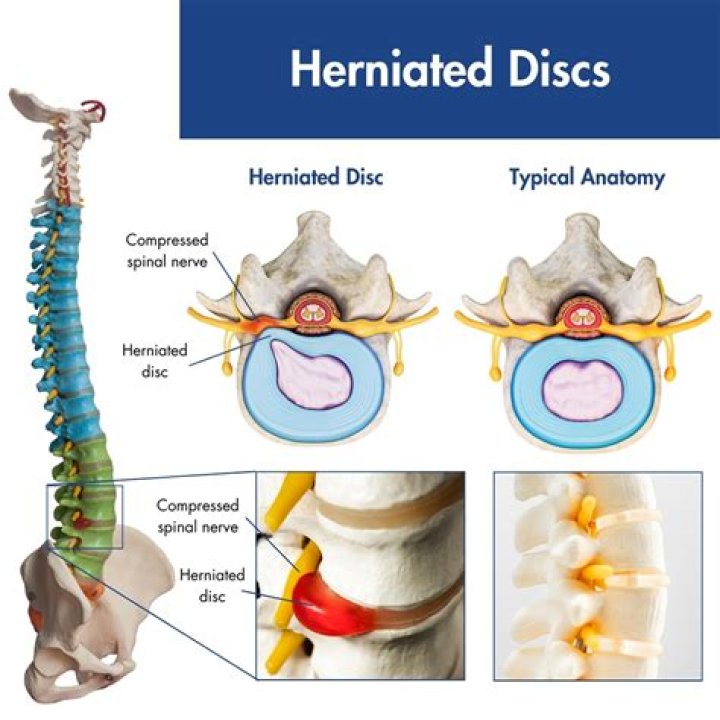 Can Hgh Repair Discs