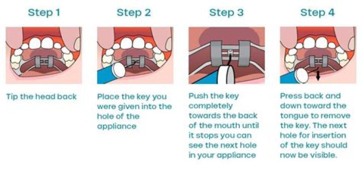 Question: How To Tighten An Expander