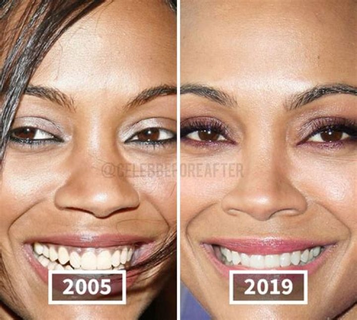 Zoe Saldaa's Nose Job: Before And After